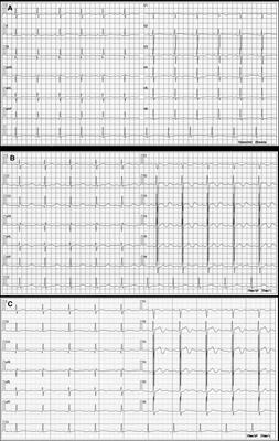 Case Report: Amiodarone-induced multi-organ toxicity